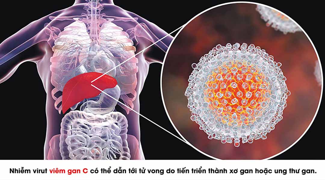 Điều trị khỏi viêm gan virut C - Cơ hội cho tất cả người bệnh