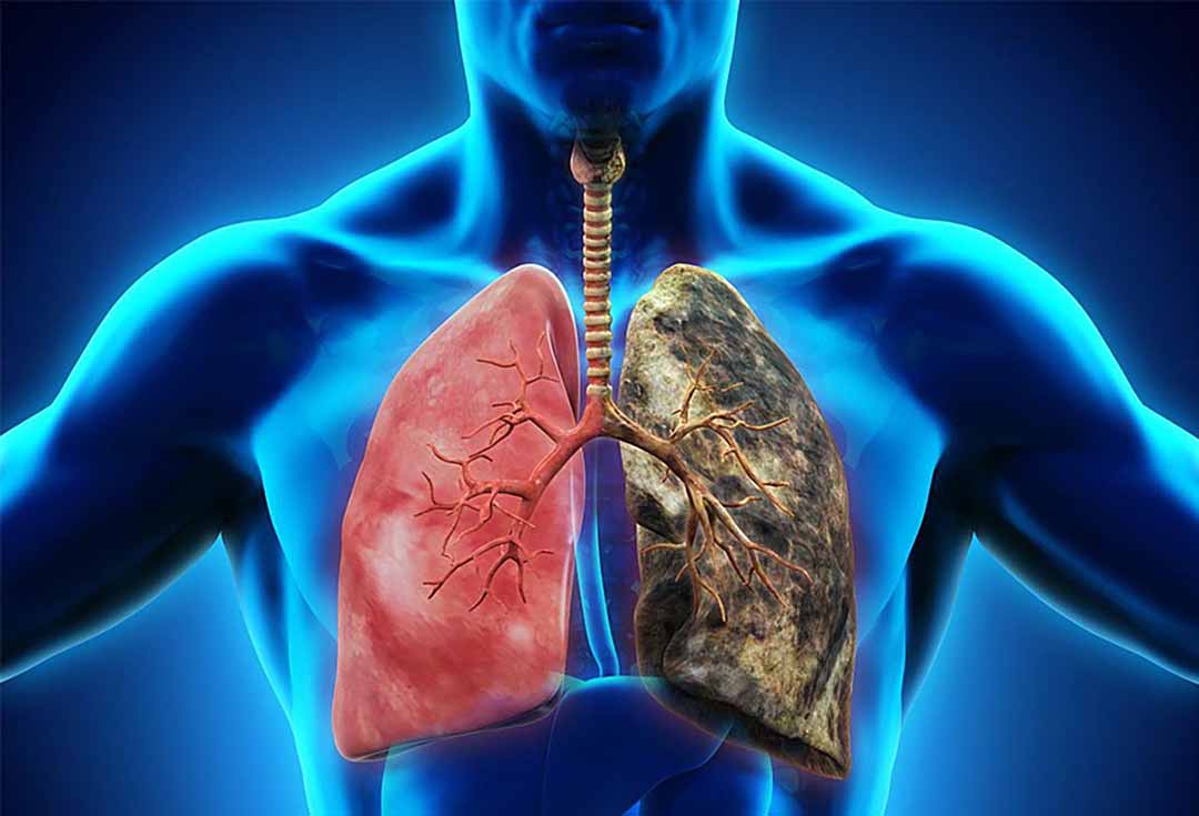 Chẩn đoán và điều trị viêm phổi: Mong đợi điều gì?