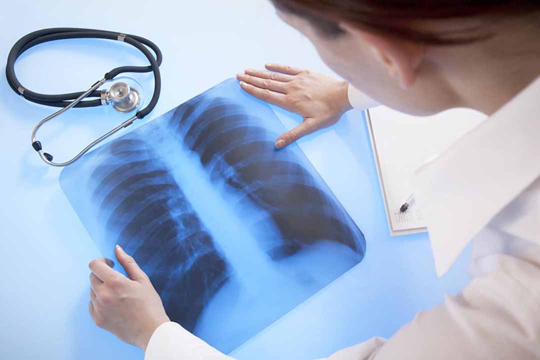 Các biến chứng của viêm phổi là gì?