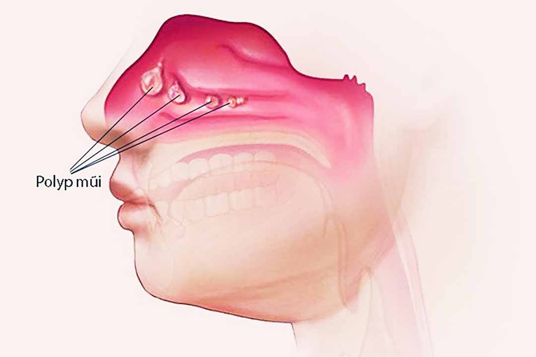Bệnh Polyp mũi là gì?