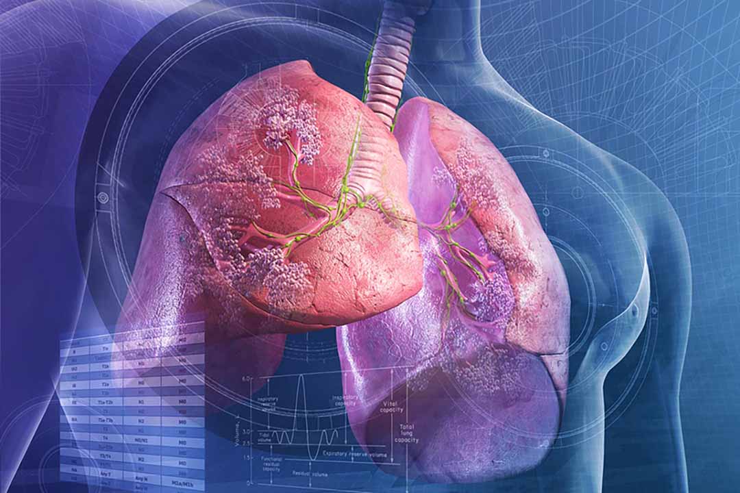 Biến chứng của viêm phổi: gây suy hô hấp, suy thận, suy tim