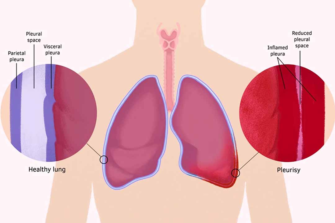 Viêm màng phổi: Những điều bạn nên biết