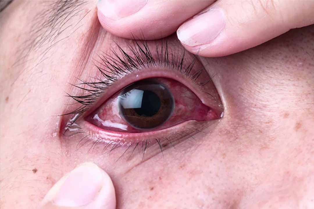 Đau mắt: Nguyên nhân là gì?