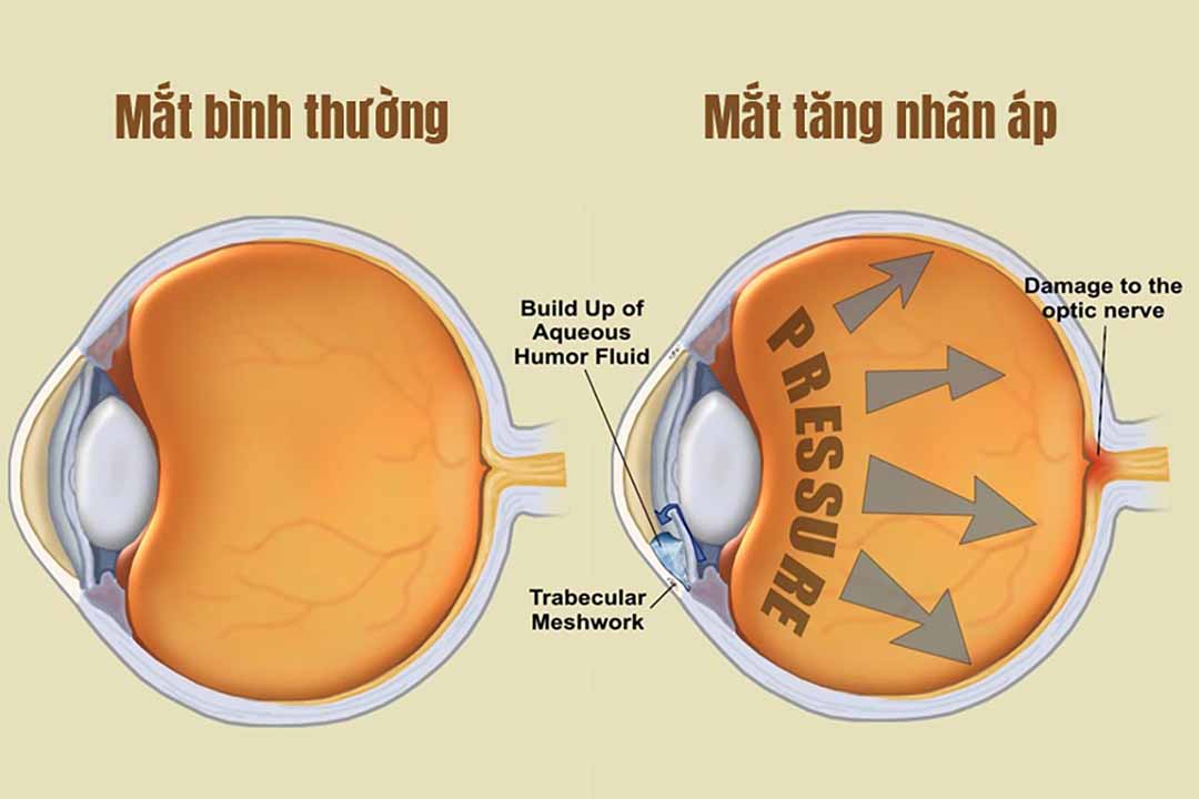 Bệnh tăng nhãn áp là gì?