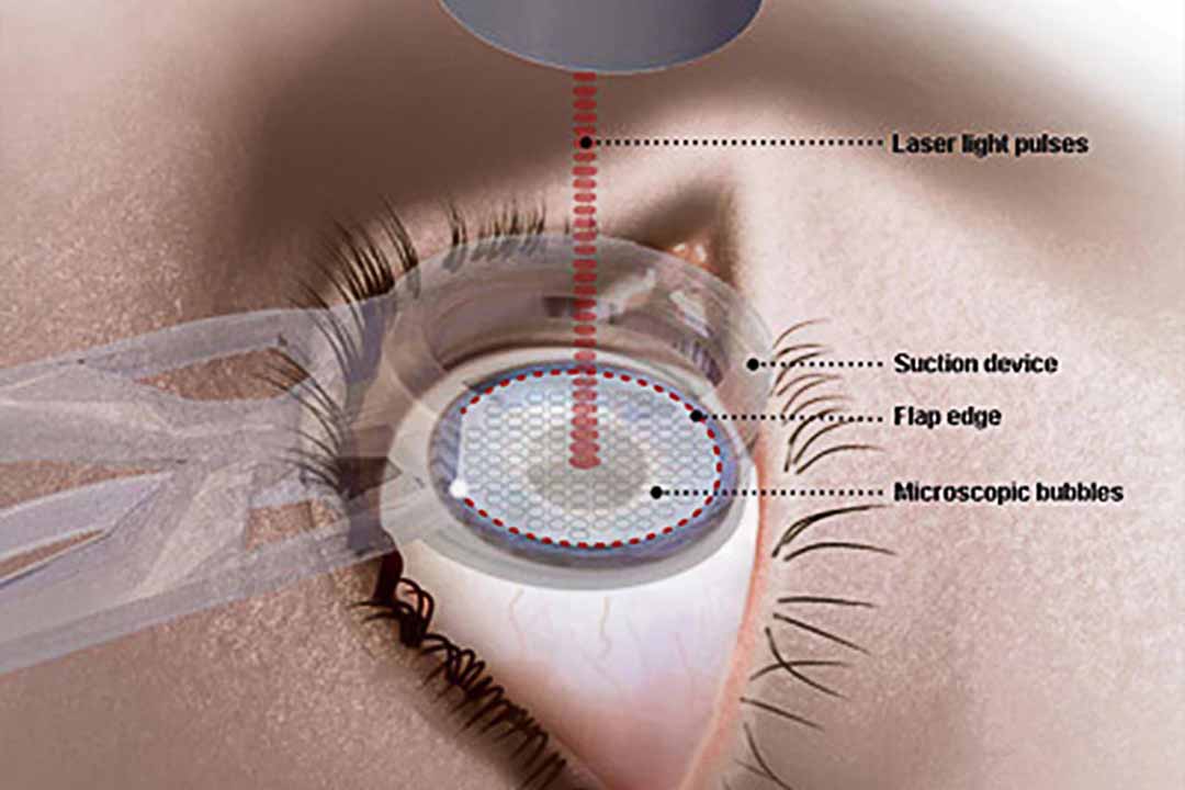 LASIK: phân biệt tính hiệu quả và rủi ro