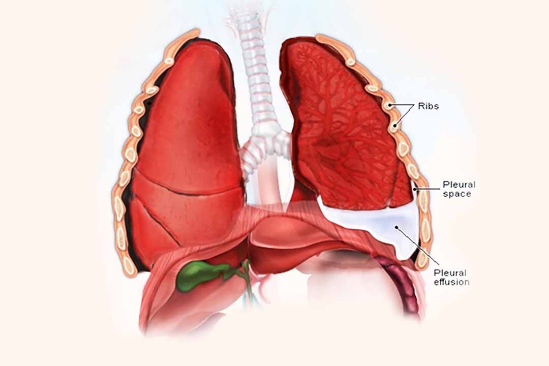 Tràn dịch màng phổi, nguyên nhân và triệu chứng