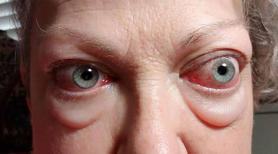 Mắt lồi (Exophthalmos)