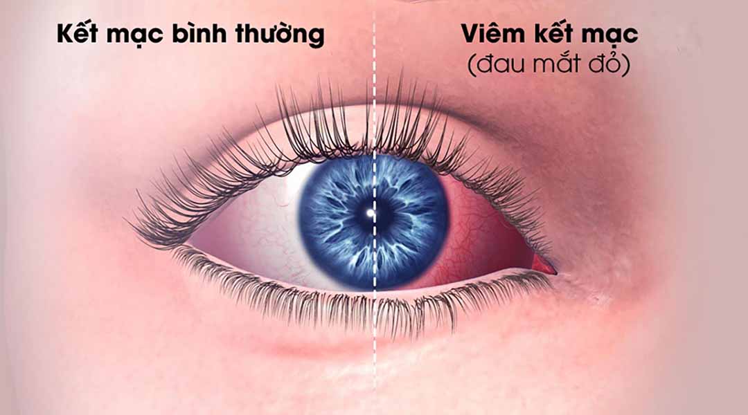 So sánh giữa kết mạc bình thường và viêm kết mạc (đau mắt đỏ).