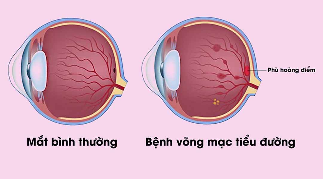 Các mạch máu nhỏ bị tổn thương sưng lên và rò rỉ.