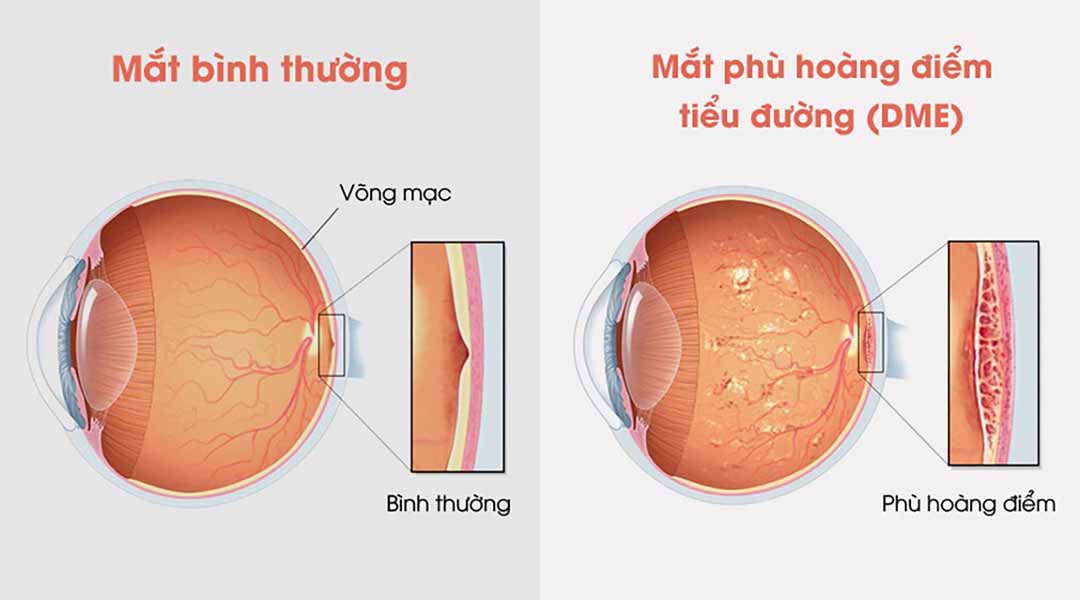 Các vấn đề về mắt liên quan đến phù hoàng điểm tiểu đường (DME)