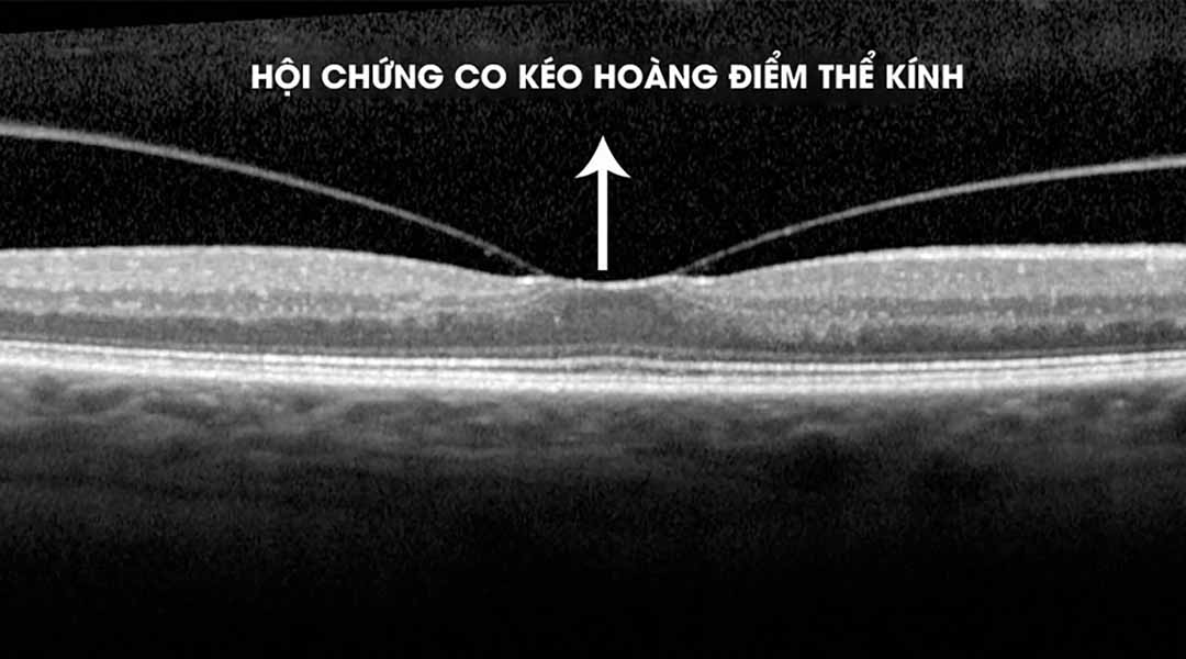 Ảnh minh họa "Hội chứng co kéo hoàng điểm thể kính (Vitreomacular Traction - VMT)".