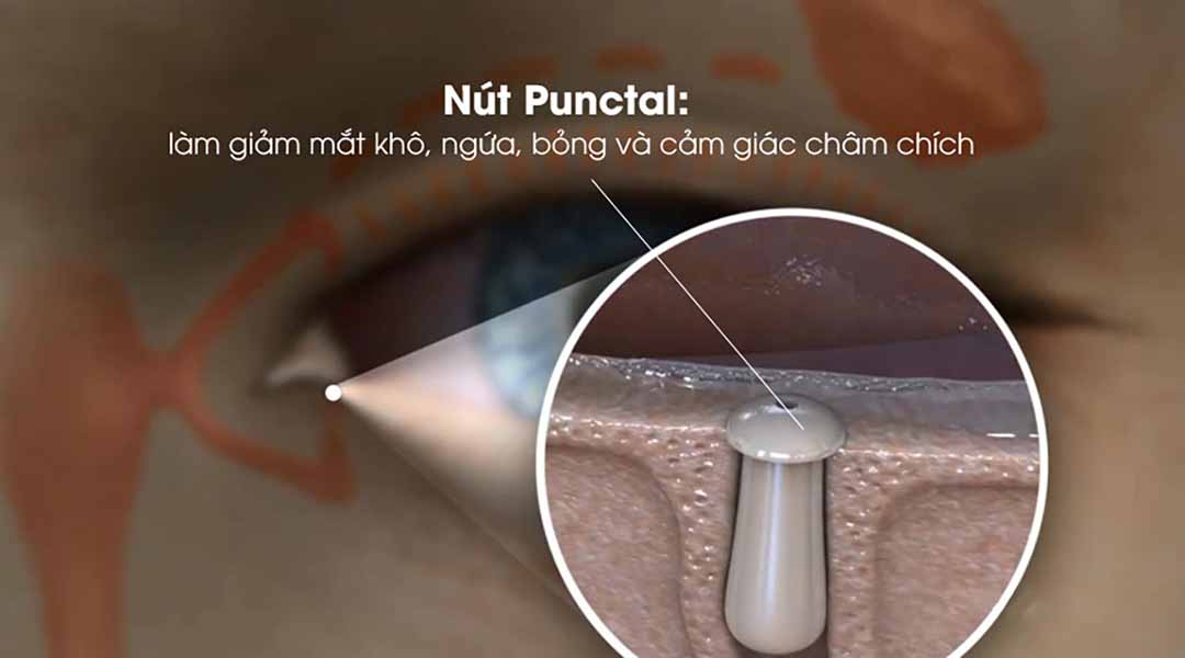 Làm thế nào để nút "Punctal" hoạt động?