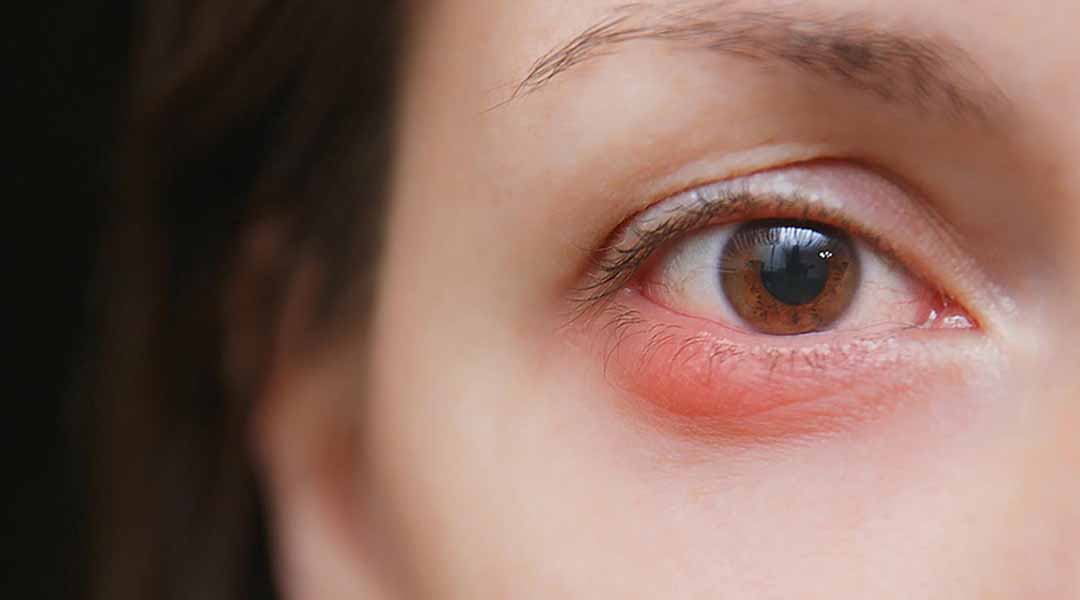 Một mụt lẹo ở mí mắt hoặc một Chalazion (chắp) cũng là nguyên nhân khiến mắt bạn chảy nước.