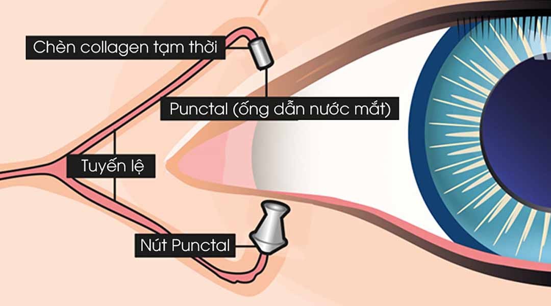 Quá trình chèn nút Punctal cho mắt.