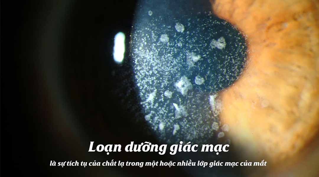 Chứng loạn dưỡng giác mạc