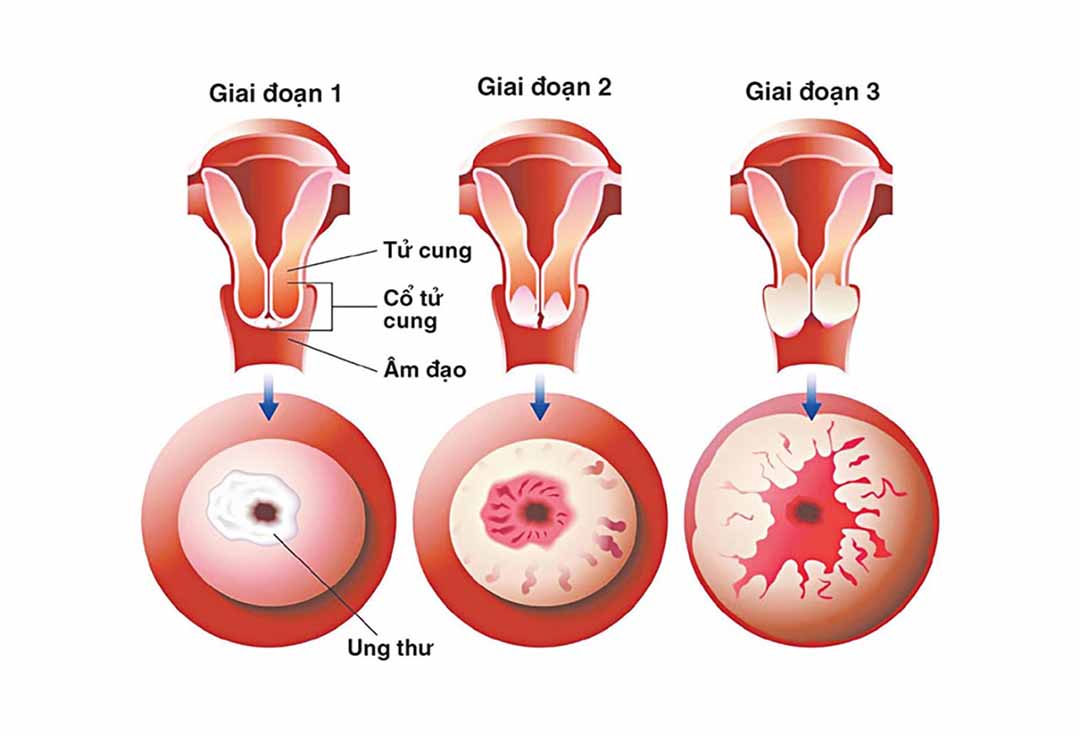Giai đoạn của ung thư cổ tử cung
