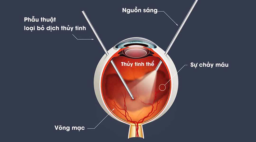 Phẫu thuật loại bỏ dịch thủy tinh (Vitrectomy) là gì?