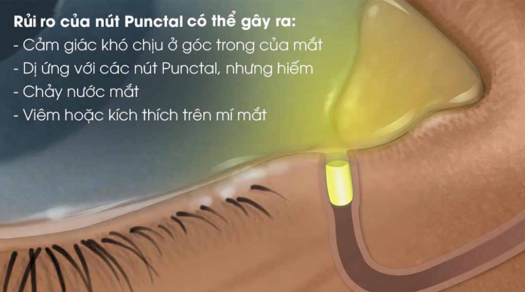 Các rủi ro mà nút "Punctal" có thể gây ra.