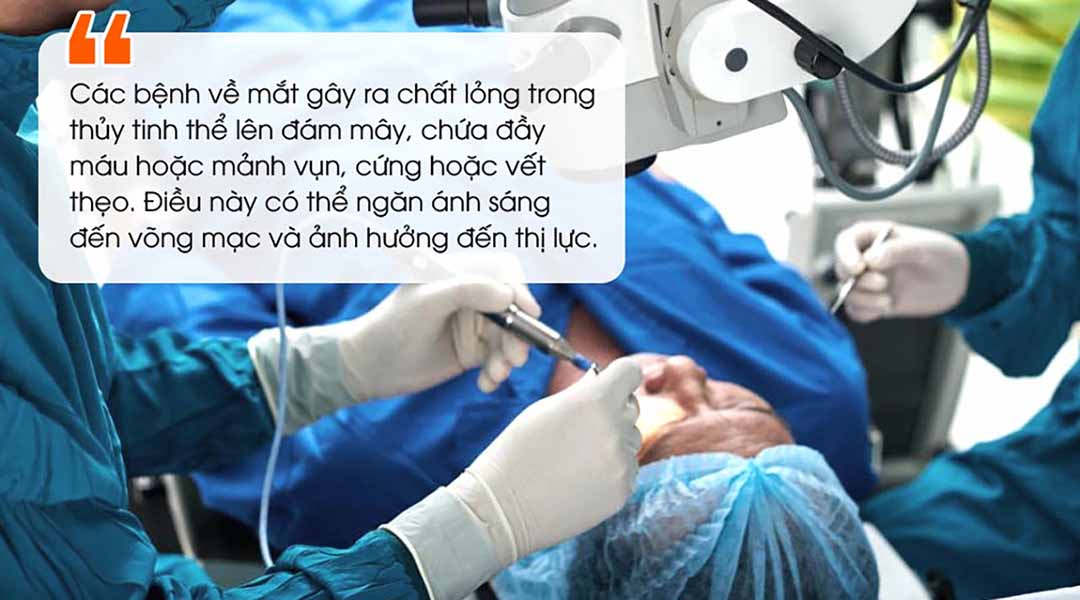 Nguyên nhân dẫn đến phẫu thuật loại bỏ dịch thủy tinh (Vitrectomy).