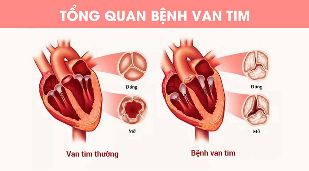 Tổng quan về bệnh van tim