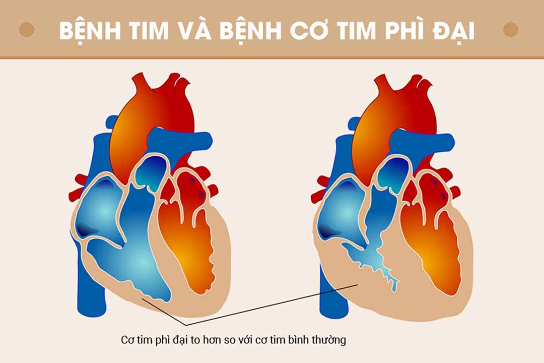 Bệnh tim và bệnh cơ tim phì đại