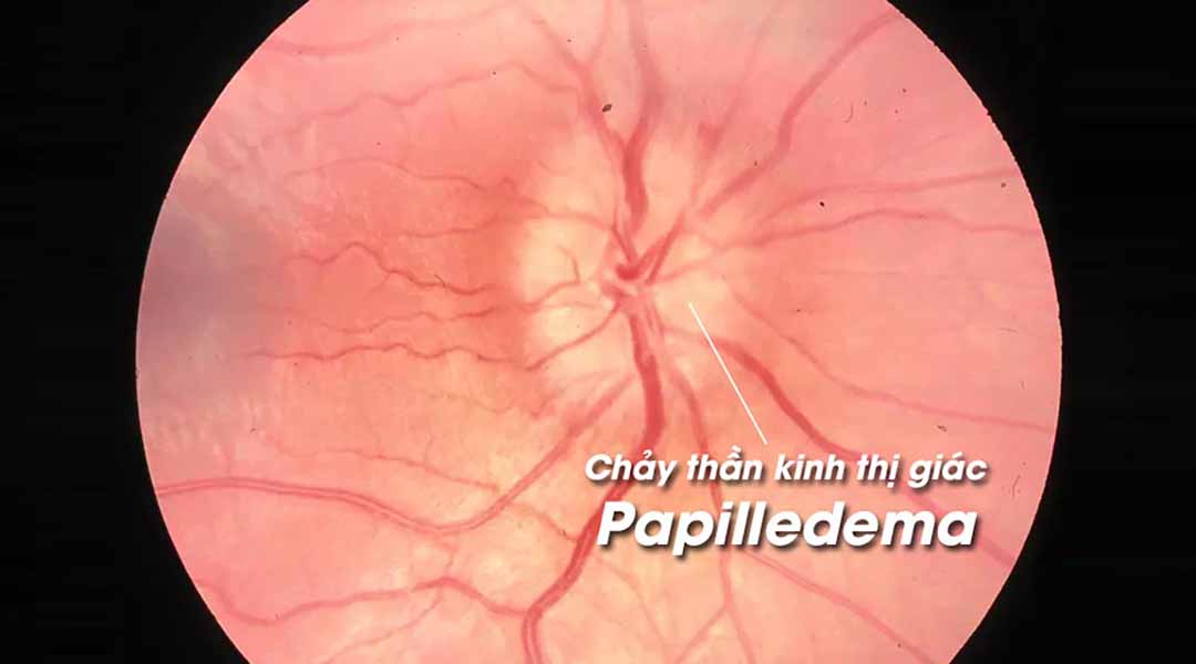 Chảy thần kinh thị giác (Papilledema) là gì?