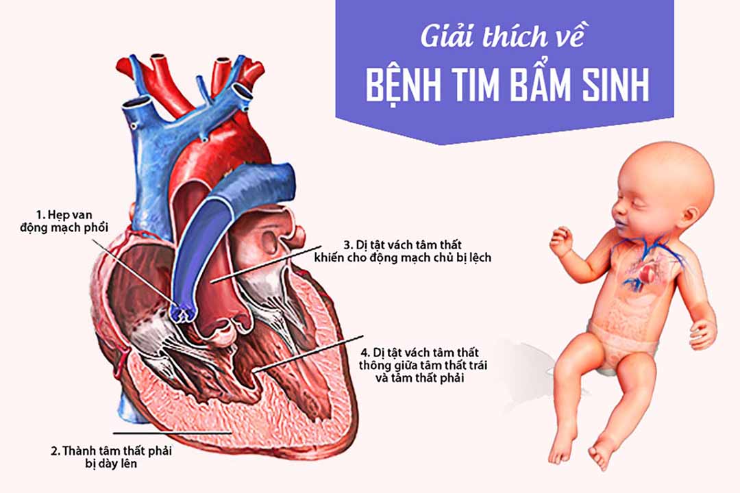 Giải thích về bệnh tim bẩm sinh