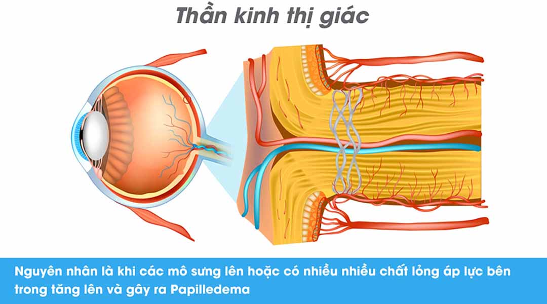 Nguyên nhân dẫn đến bệnh Papilledema.