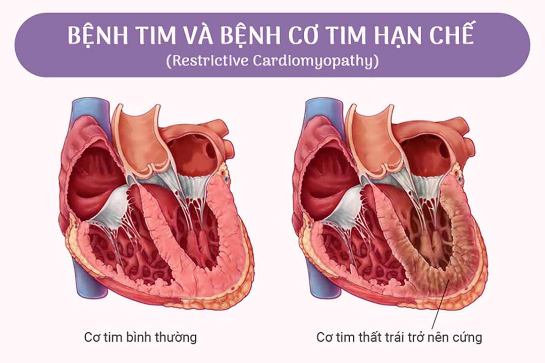 Bệnh tim và bệnh cơ tim hạn chế