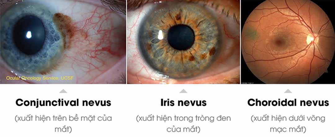 Phân biệt các loại nevus.