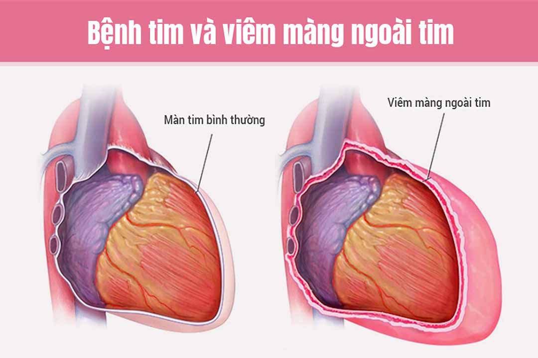 Bệnh tim và viêm màng ngoài tim