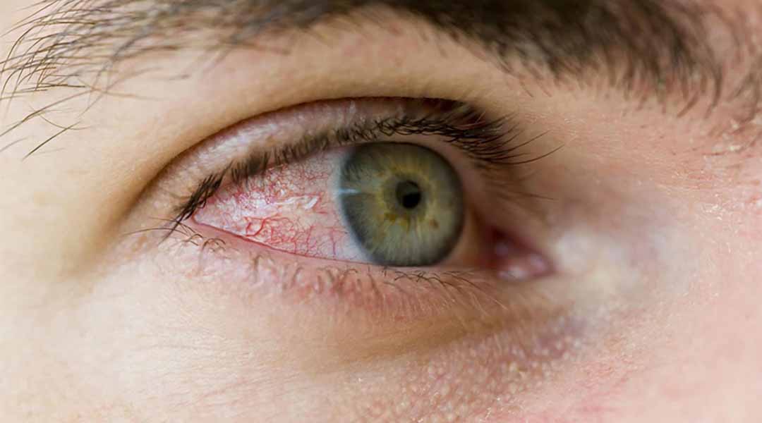 Mắt đỏ cũng có thể xảy ra khi huyết áp tăng đột biến.