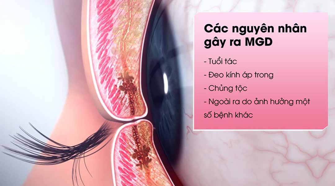 Các nguyên nhân có thể dẫn đến MGD.