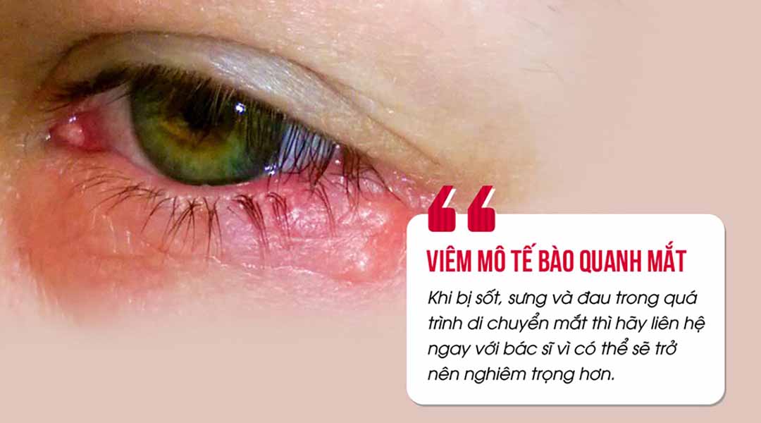 Các triệu chứng thường thấy ở viêm mô tế bào quanh mắt.