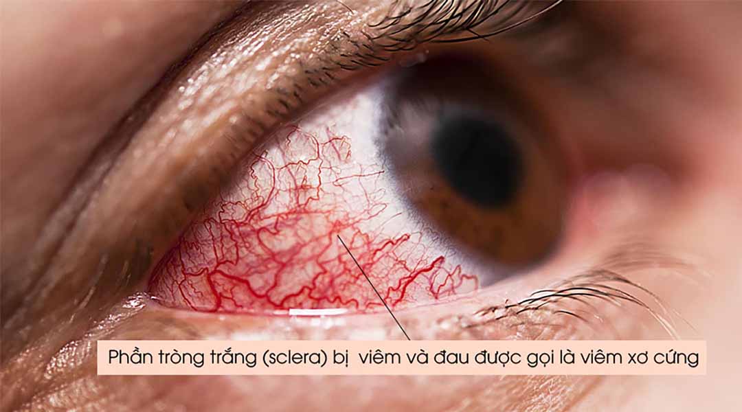 Viêm xơ cứng ở mắt là gì?