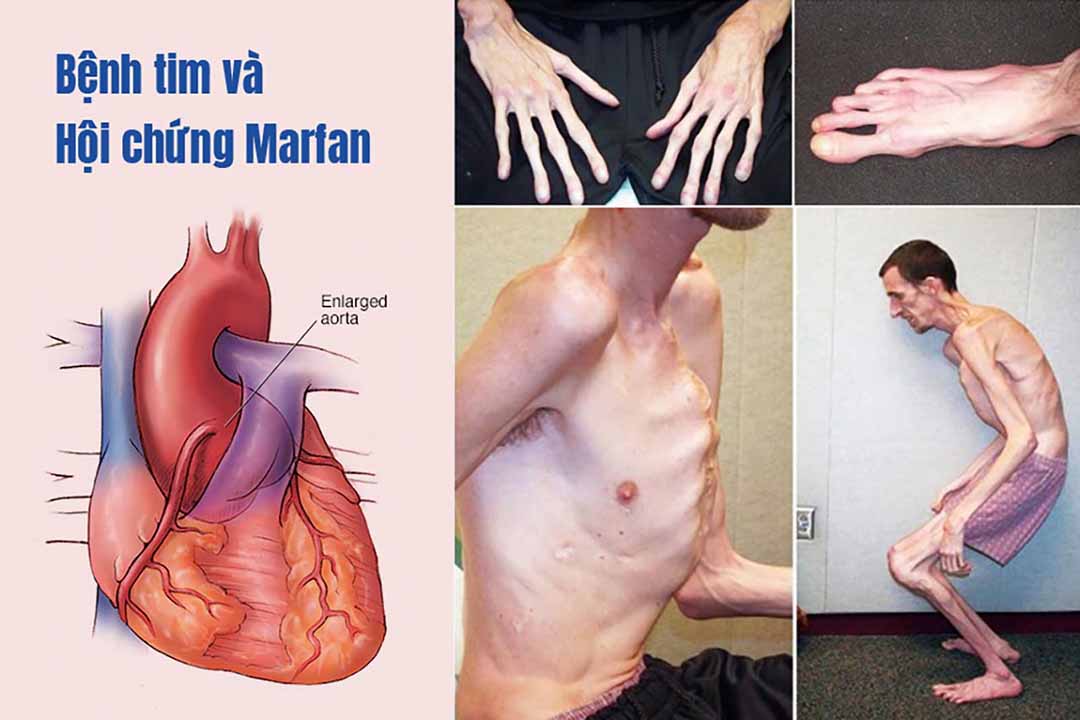 Bệnh tim và Hội chứng Marfan