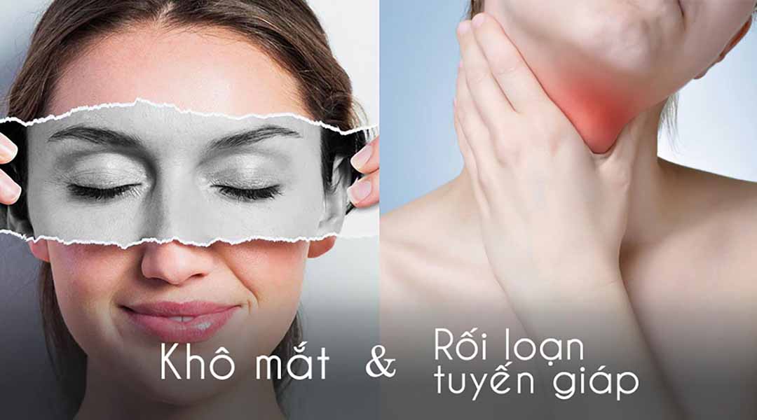 Khô mắt và rối loạn tuyến giáp có liên quan như thế nào?