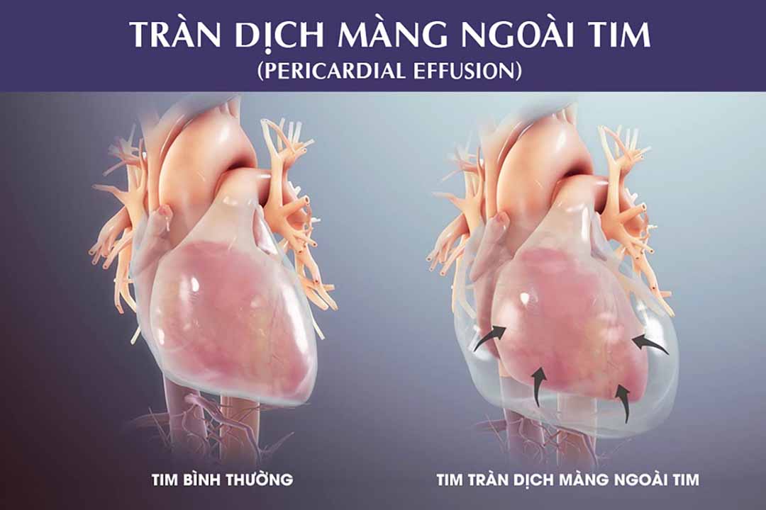 Những điều cần biết: Tràn dịch màng ngoài tim (Pericardial Effusion)