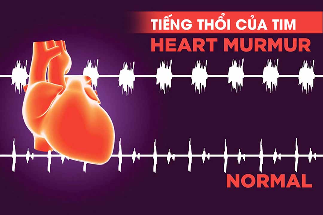 Tiếng thổi của tim (Heart Murmurs) là gì?