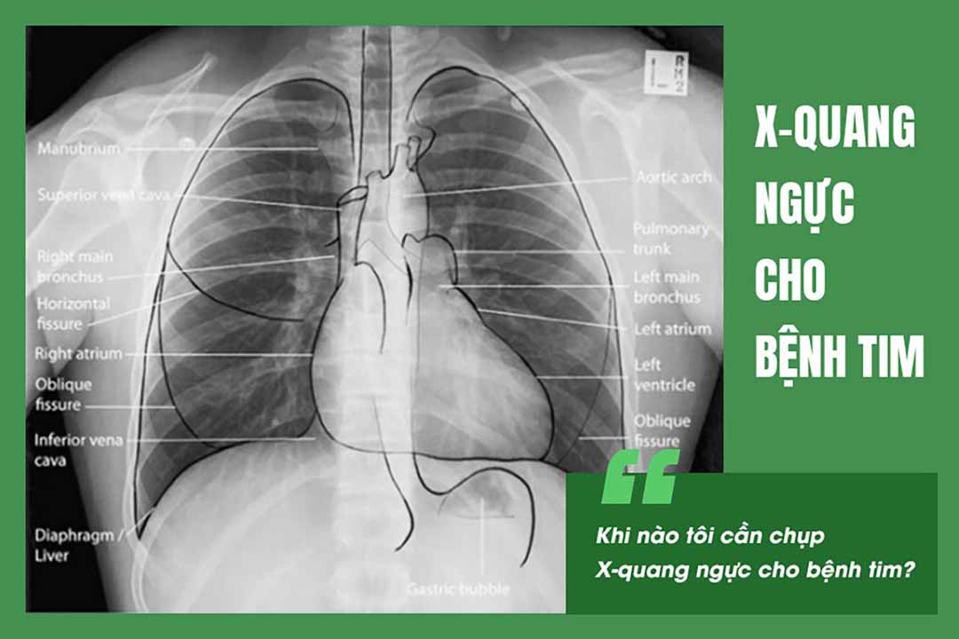 Khi nào tôi cần chụp X-quang ngực cho bệnh tim?