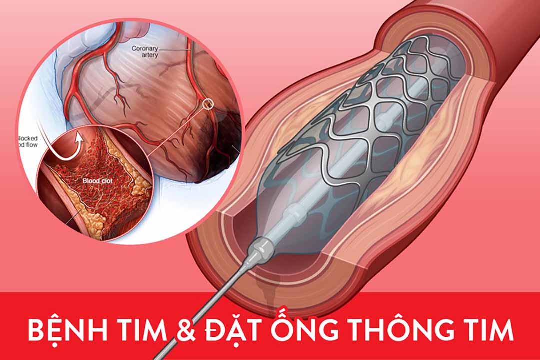 Bệnh tim và Đặt ống thông tim