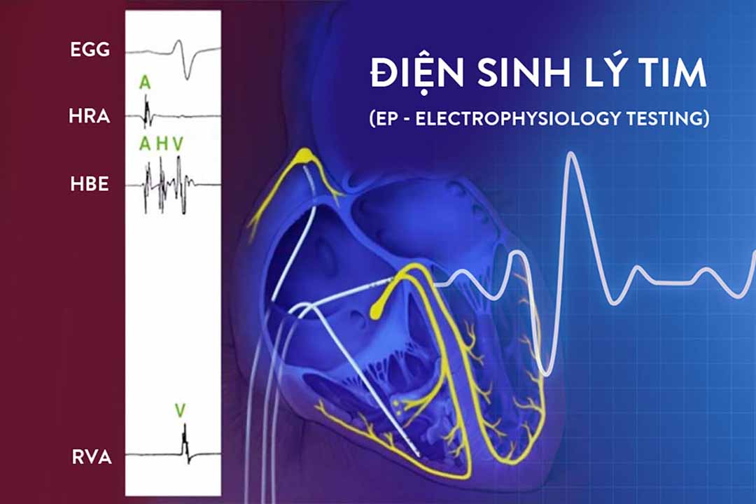 Bệnh tim và Xét nghiệm điện sinh lý tim