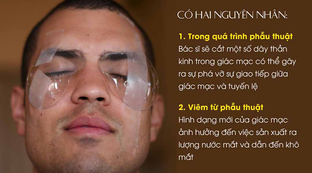 Nguyên nhân gây khô mắt từ phẫu thuật LASIK.