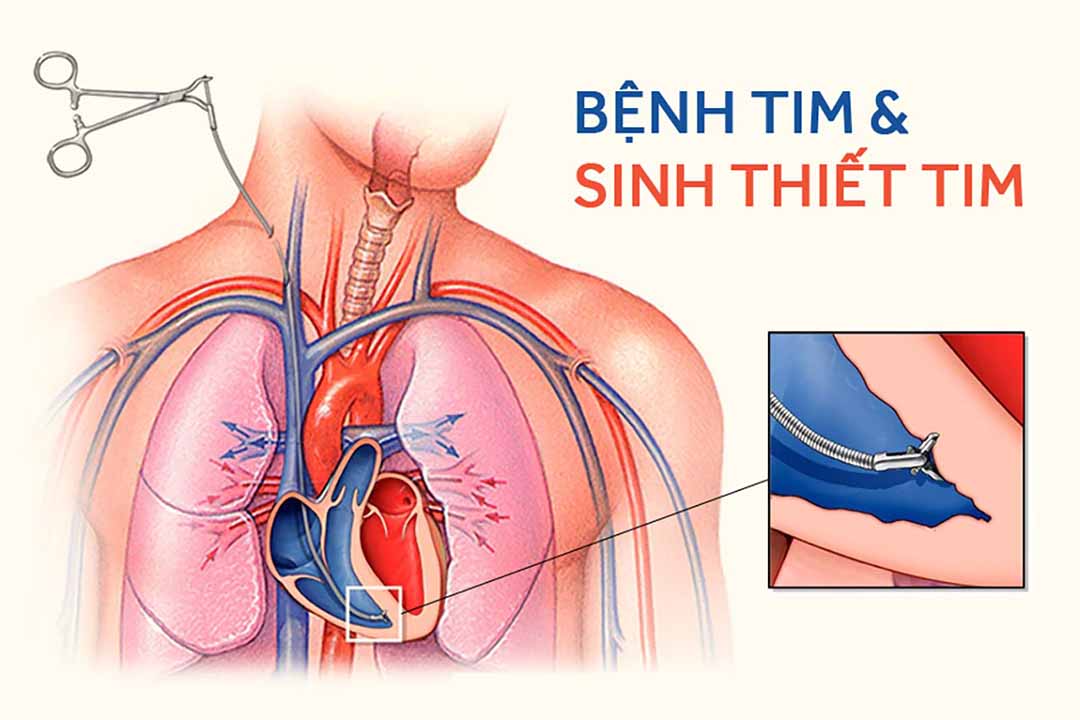 Bệnh tim và sinh thiết tim