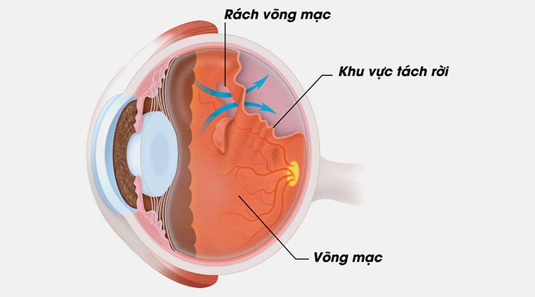 3 loại tách võng mạc