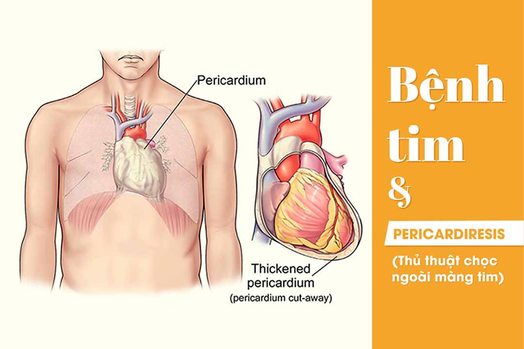 Bệnh tim và Pericardiresis (thủ thuật chọc ngoài màng tim)