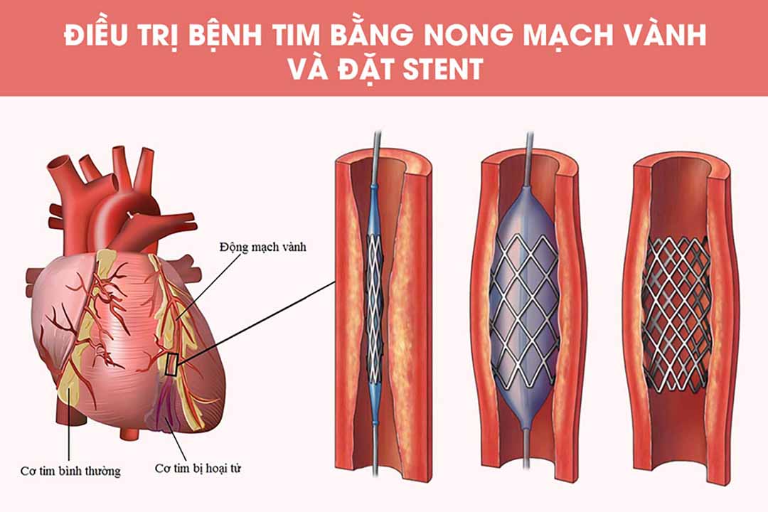 Điều trị bệnh tim bằng nong mạch vành và đặt stent