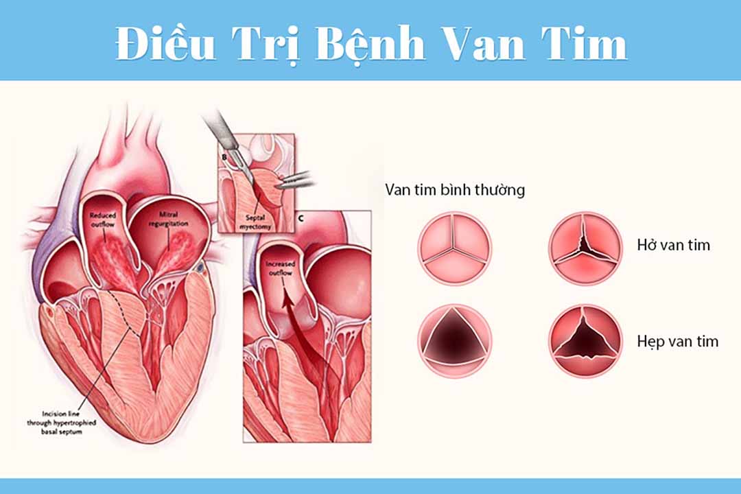 Điều trị bệnh van tim