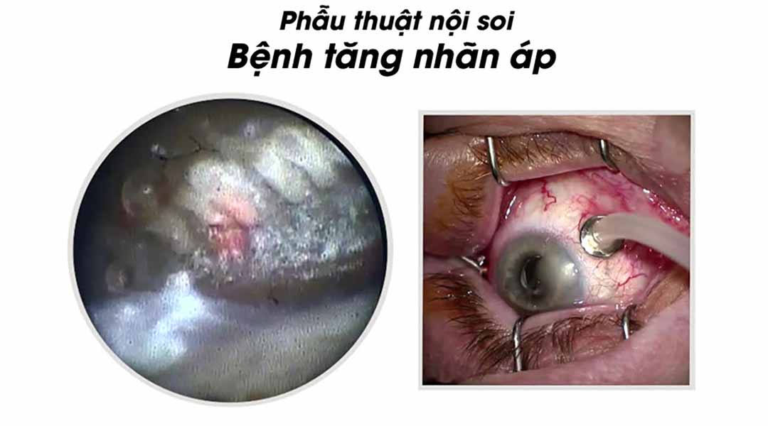 Phẫu thuật nội soi là phổ biến cho bệnh tăng nhãn áp.