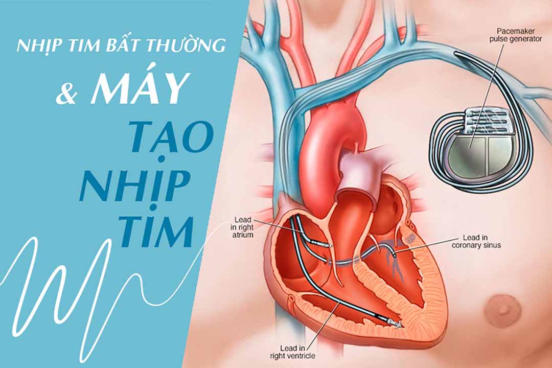 Nhịp tim bất thường và máy tạo nhịp tim